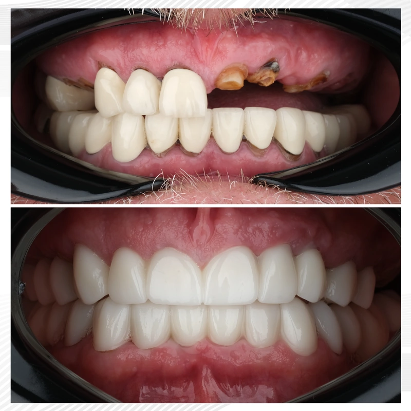 dental implants whole mouth before after