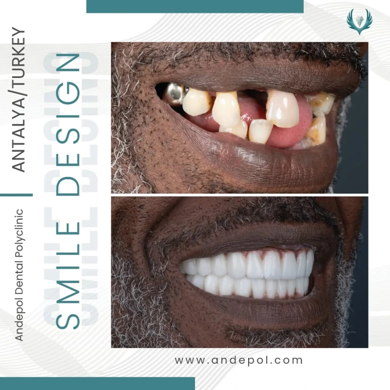 full mouth dental implant before after
