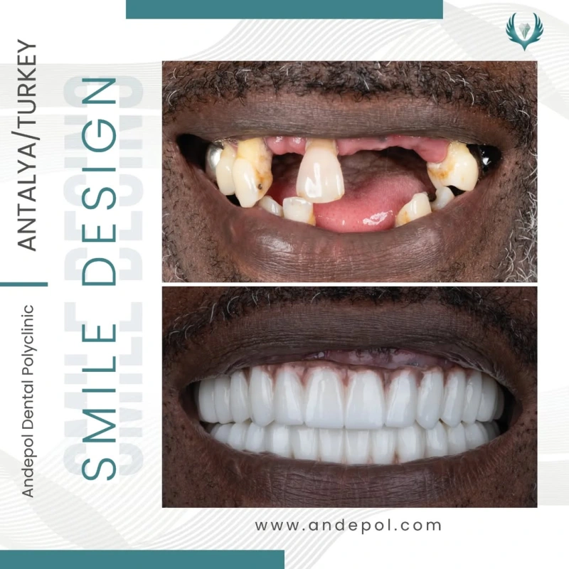 whole mouth dental implants before after