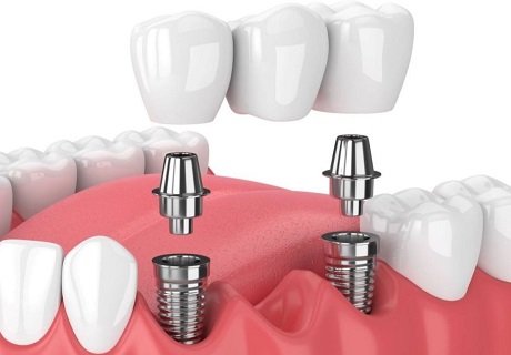 3 Teeth Implant Bridge