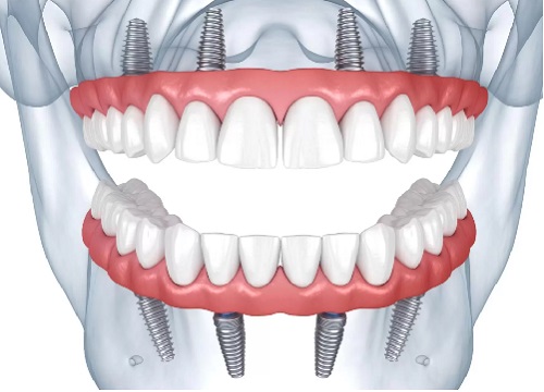 4 in 1 full mouth restorations