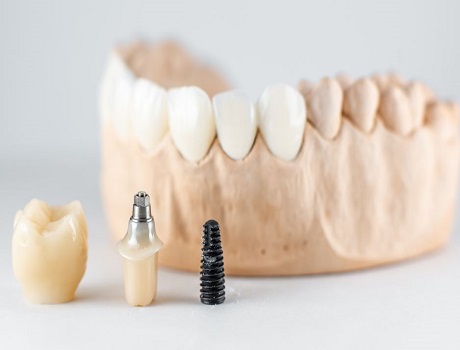 4 in 1 Zirconia Prosthetics