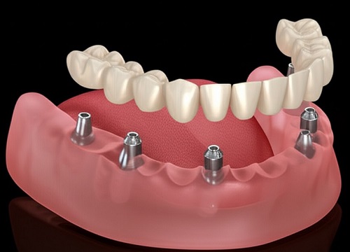 All on 6 Dental Implants Turkey