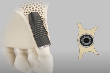 Alveolar Crest Augmentation