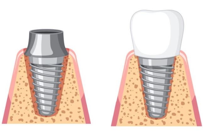 attachment permanent prostetic teeth stage turkey