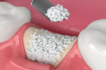 Bone Grafting