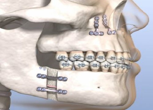 Corrective jaw surgery