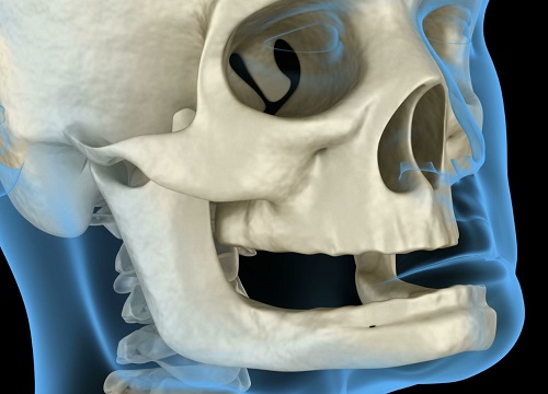 Jaw Surgery Costs