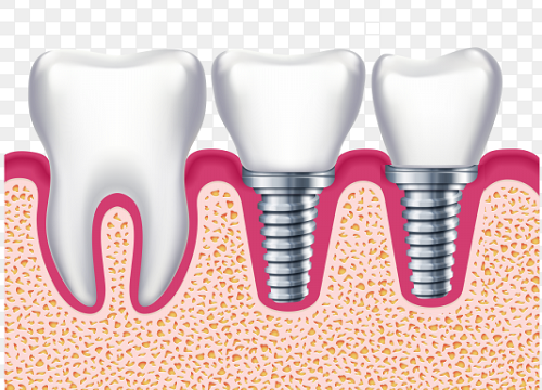 Cost of Bone Grafting