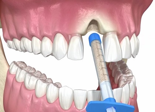 Cost of 2 Dental Implants With Bone Grafting