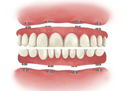 Dental Implant Cost Whole Mouth