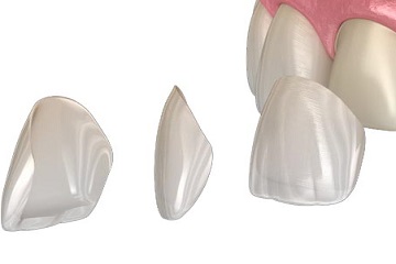 Dental Veneers