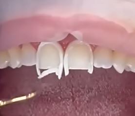 direct composite bonding