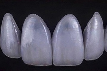 Emax Veneers