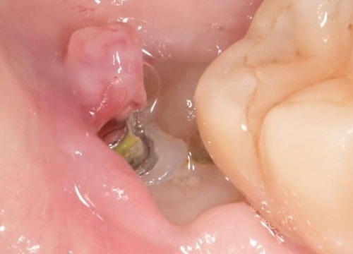 Exposed Nerve Ending