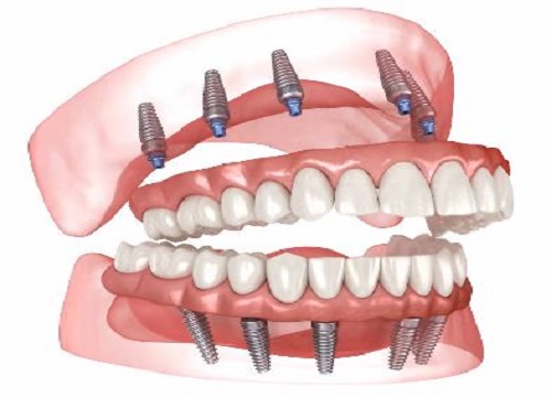 Full Mouth Reconstruction