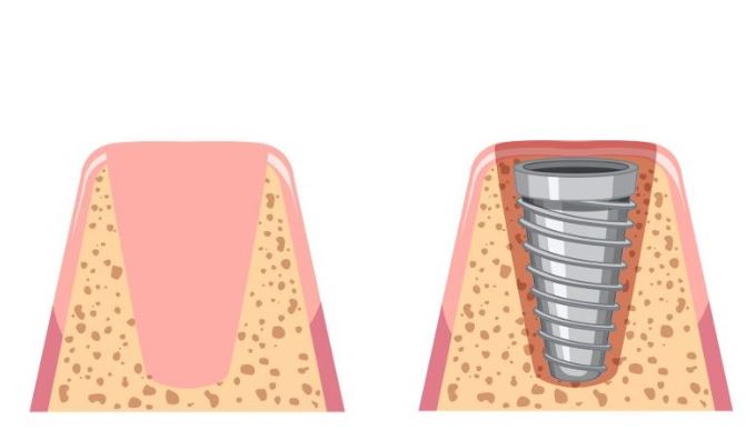 implant placement stage turkey