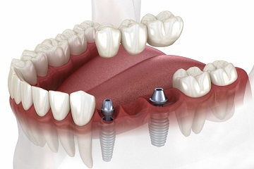 Implant Supported Bridge
