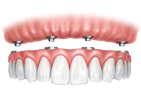 Implant Supported Bridges