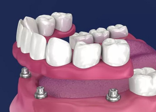 Implant Supported Partial Denture