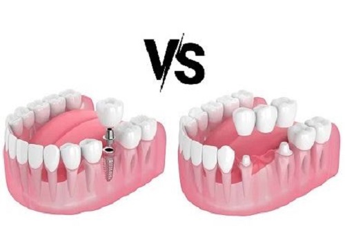 Bridge vs Implants