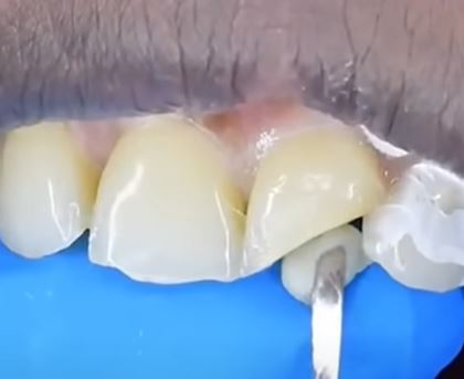 Injection Molded composite bonding