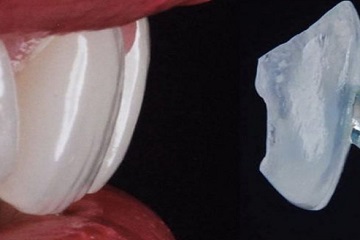 Laminate Veneers