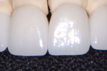Lumineer Veneers