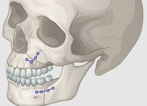 Orthognathic jaw surgery