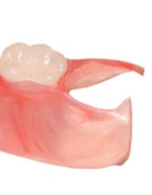 Single Tooth Denture