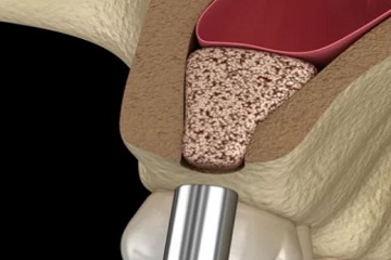 Sinus Lift