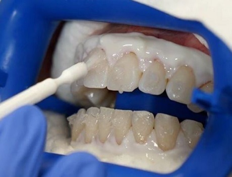 teeth whitening gel process