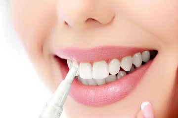 Teeth Whitening