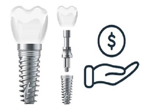Teeth Implant Prices