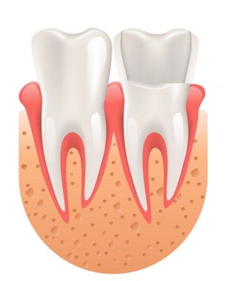 veneers stage 1