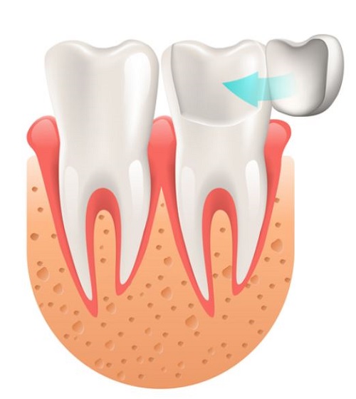 veneers stage 2