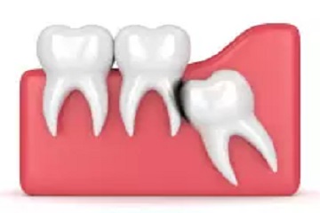 wisdom teeth coming out at an angle