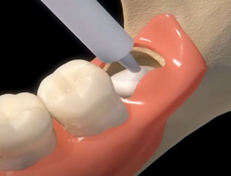 Filling the cavity after wisdom tooth extraction