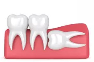 wisdom teeth horizontal protrusion