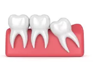 wisdom teeth mesial eruption