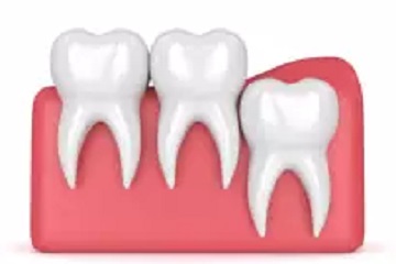 ywisdom teeth vertical eruption