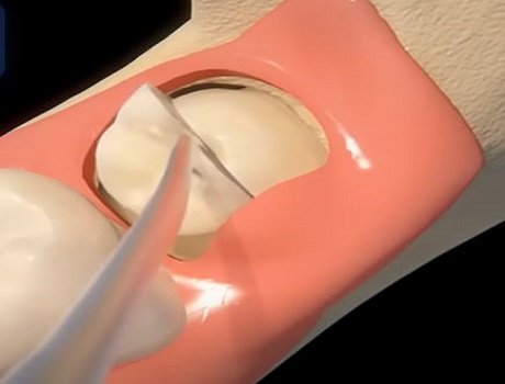 Extraction of wisdom tooth incisor
