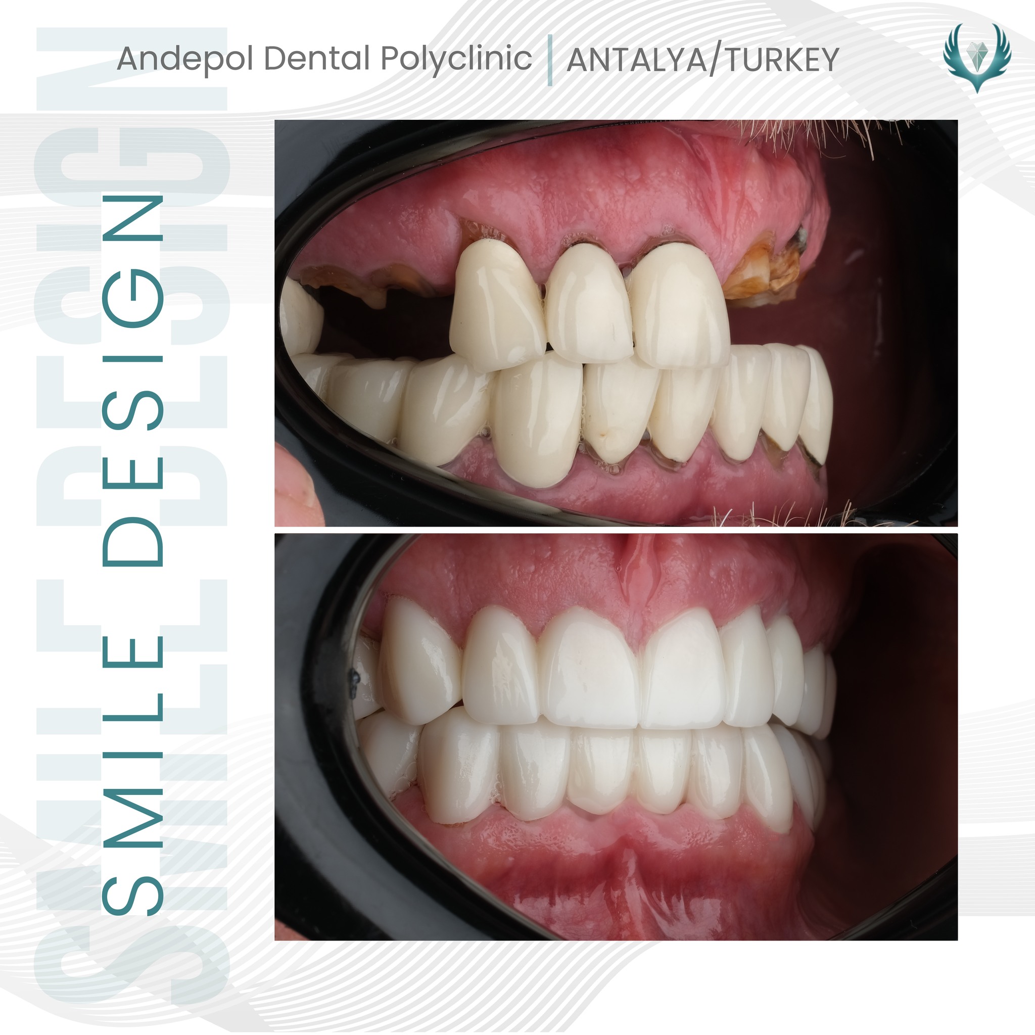 all-on-six implant öncesi sonrası