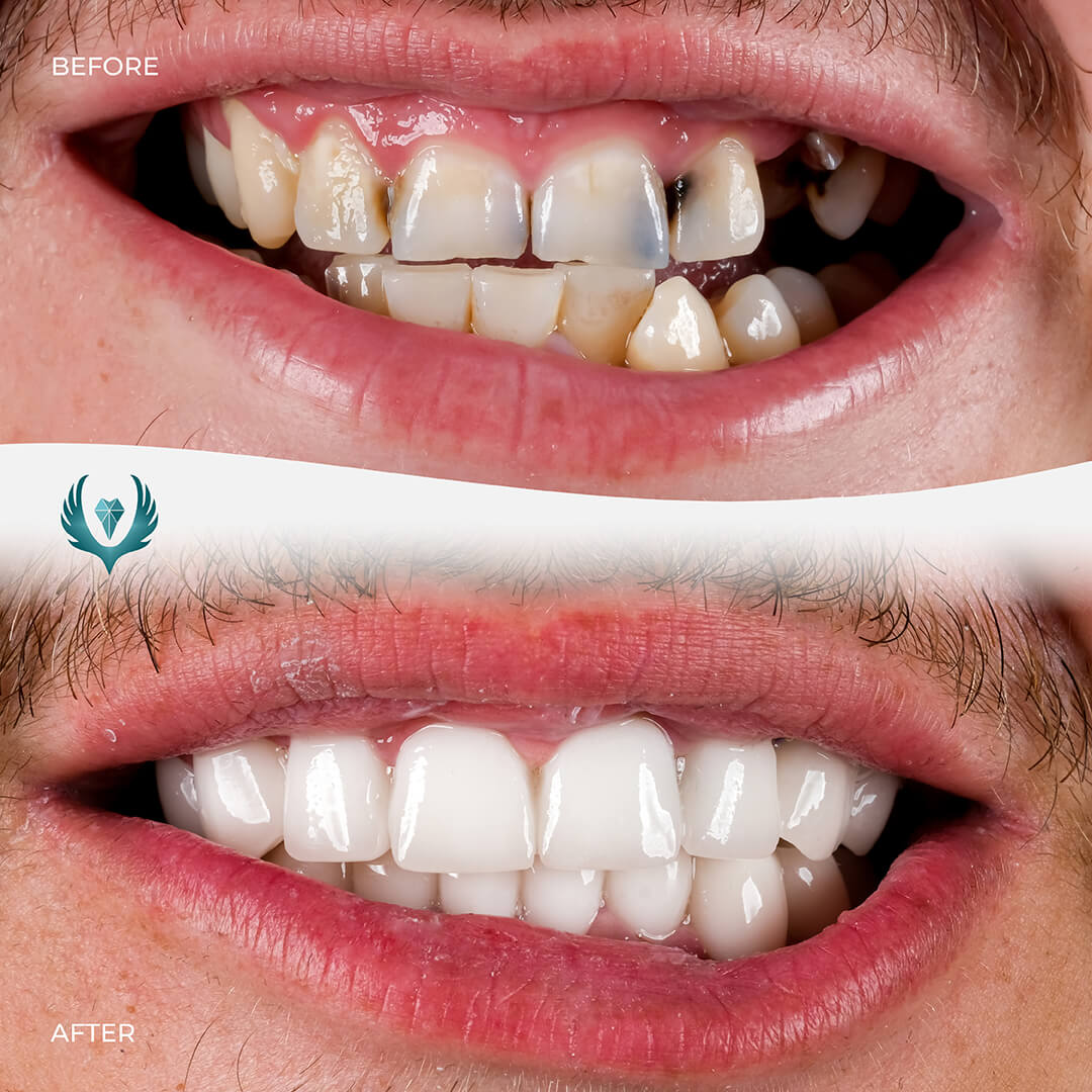 andepol klinik antalya implant diş öncesi sonrasi hasta gülüşü