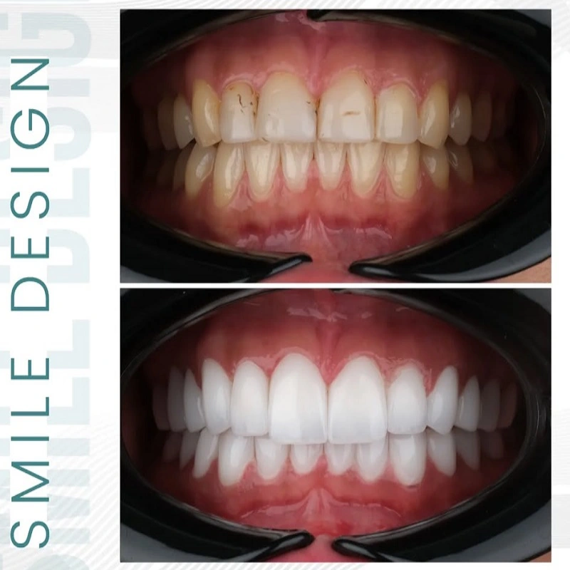 Hollywood smile öncesi ve sonrası - Anastasia 2 (Antalya)