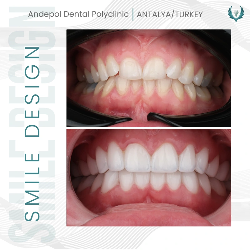 Hollywood smile öncesi ve sonrası - Ellen 2