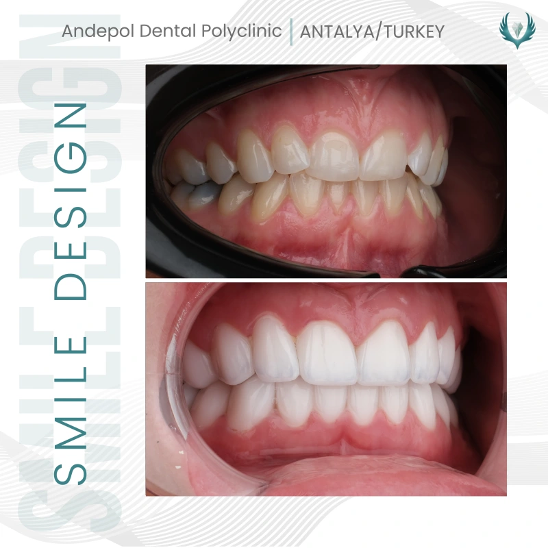 Hollywood smile öncesi ve sonrası - Ellen 4