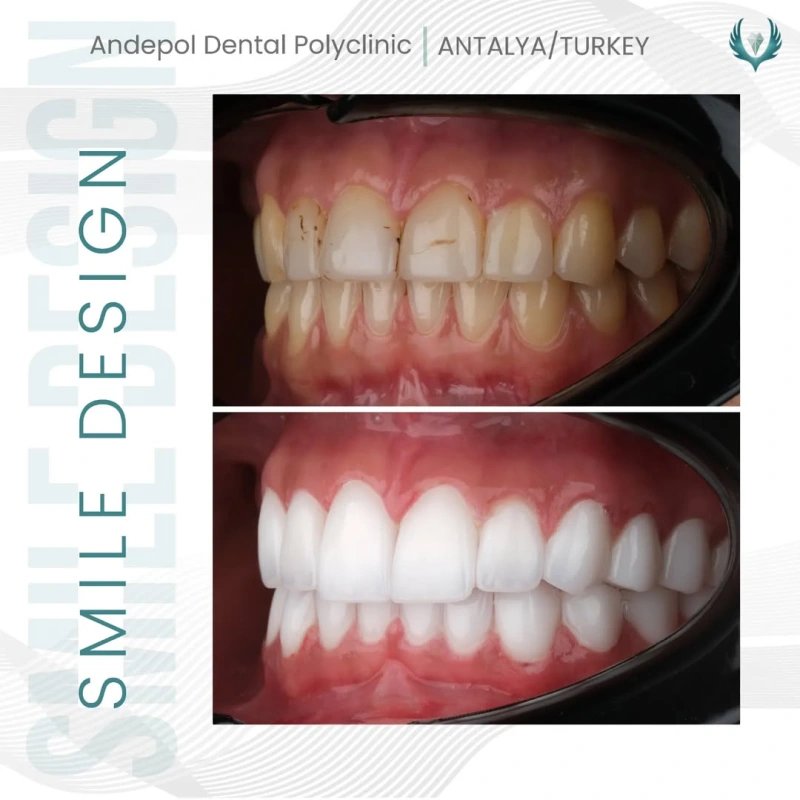 Hollywood smile öncesi ve sonrası - Talya 4