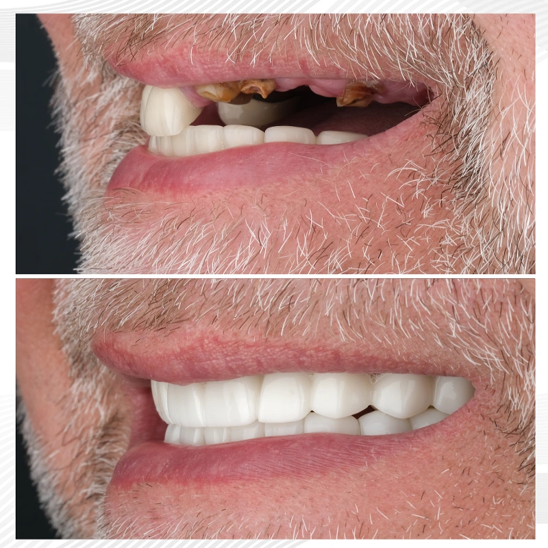 All on 6 implant diş öncesi ve sonrası