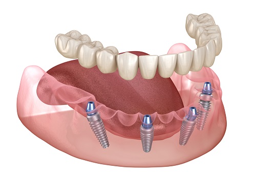 All on 4 Implant Package